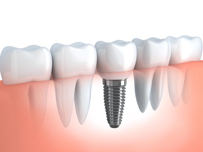 Dental Implants Austin, TX