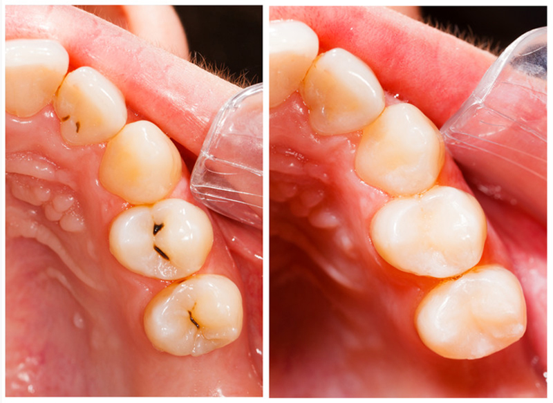 Tooth Fillings in Austin, TX | Shoal Creek Prosthodontic Group