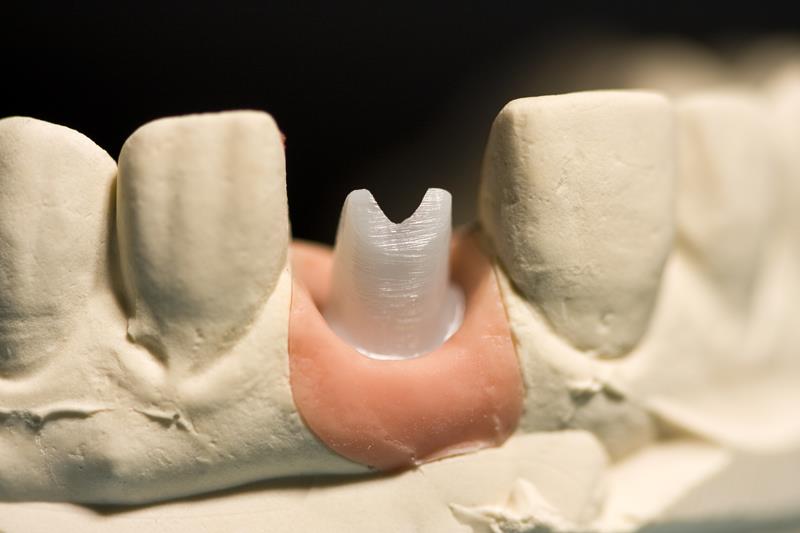 Dental Implant Restoration in Austin, TX | Shoal Creek Prosthodontic Group