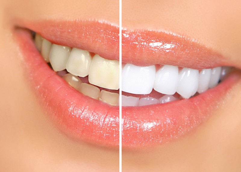 Teeth Whitening  Austin, TX