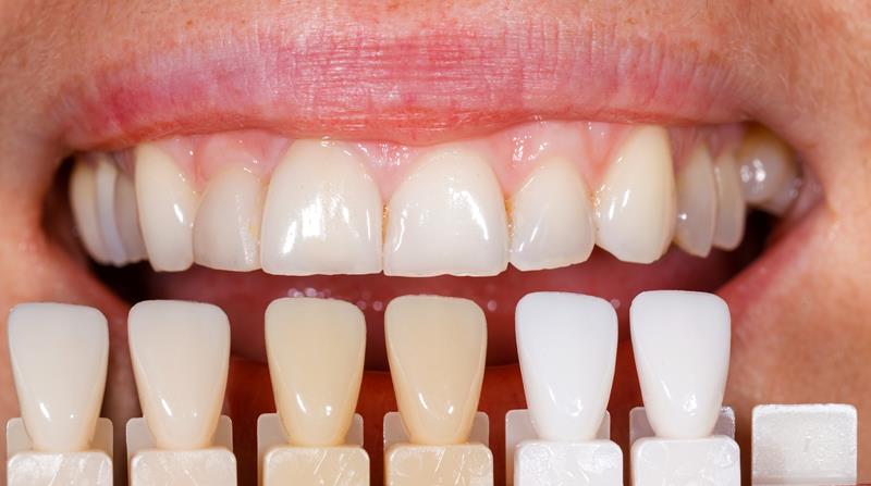Veneers  Austin, TX