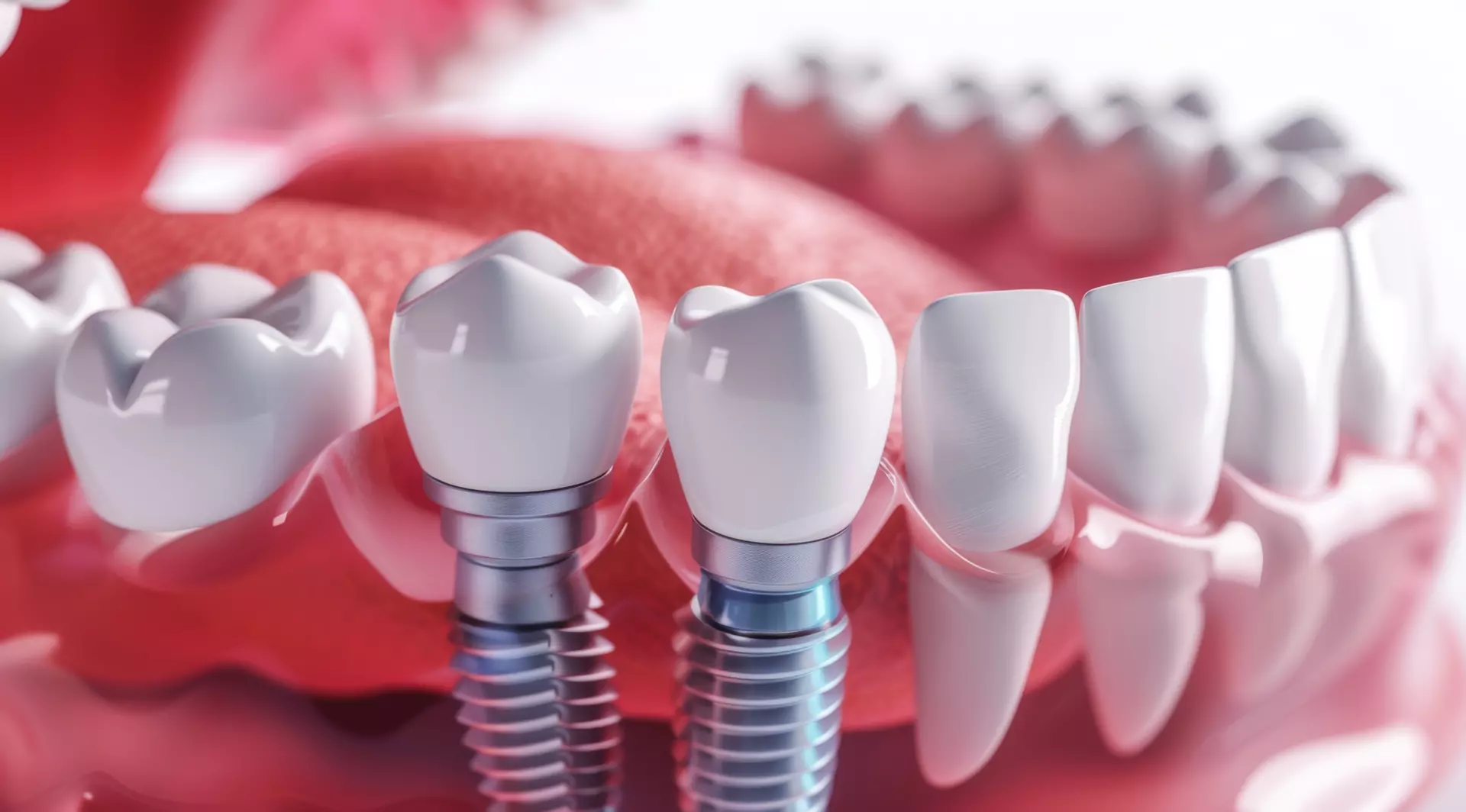 Dental Implants image